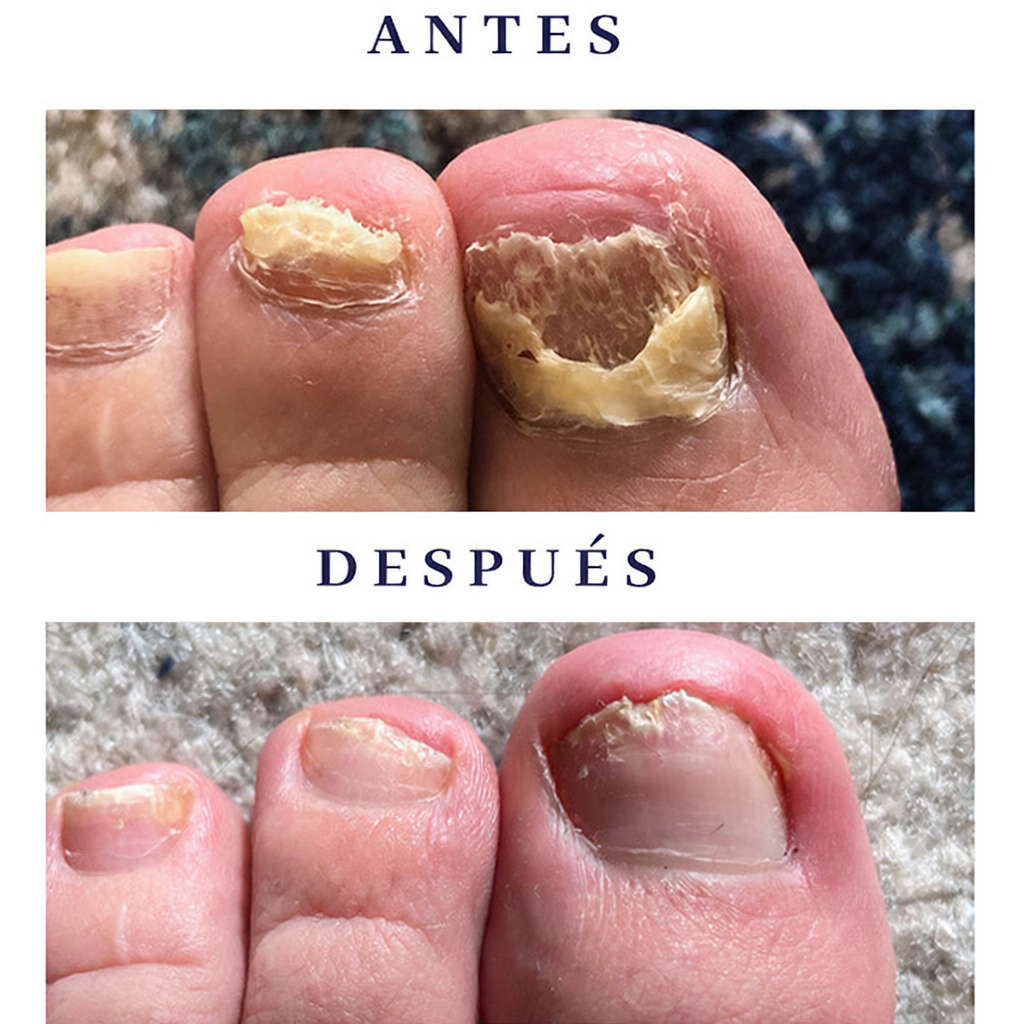 Aceite natural reparador de uñas DermaNail®