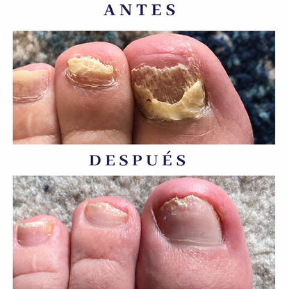 Aceite natural reparador de uñas DermaNail®